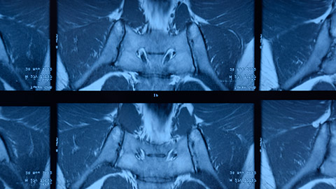 MRI sacroiliac articulation. Study of ankylosing spondyloarthritis patient. The results of the study on the x-ray.