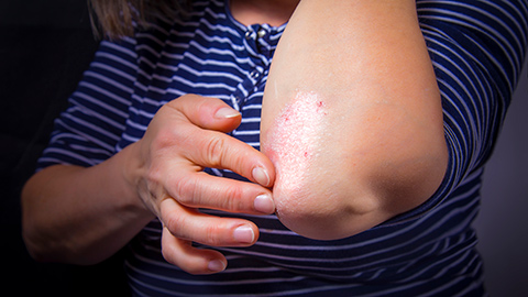 Close-up on the left elbow of a person wearing a horizontal light and dark blue striped shirt, they are touching a spot of psoriasis with their right hand