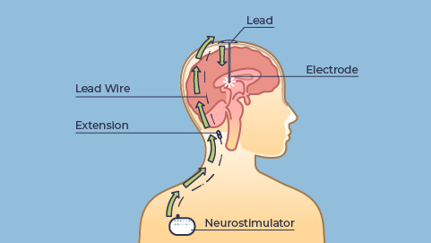 blue background with a drawing of a person with light skin from the mid torso up. The head has an illustration of the brain and a diagram of an electrode in the center, with a lead at the top of their head, then showing the lead wire, and extension down to a neurostimulator. There are green arrows from the neurostimulator going up the extension and ending at the electrode.