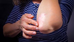 Close-up on the left elbow of a person wearing a horizontal light and dark blue striped shirt, they are touching a spot of psoriasis with their right hand