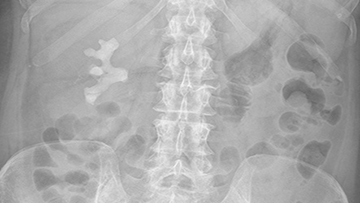 Xray image of staghorn calculus